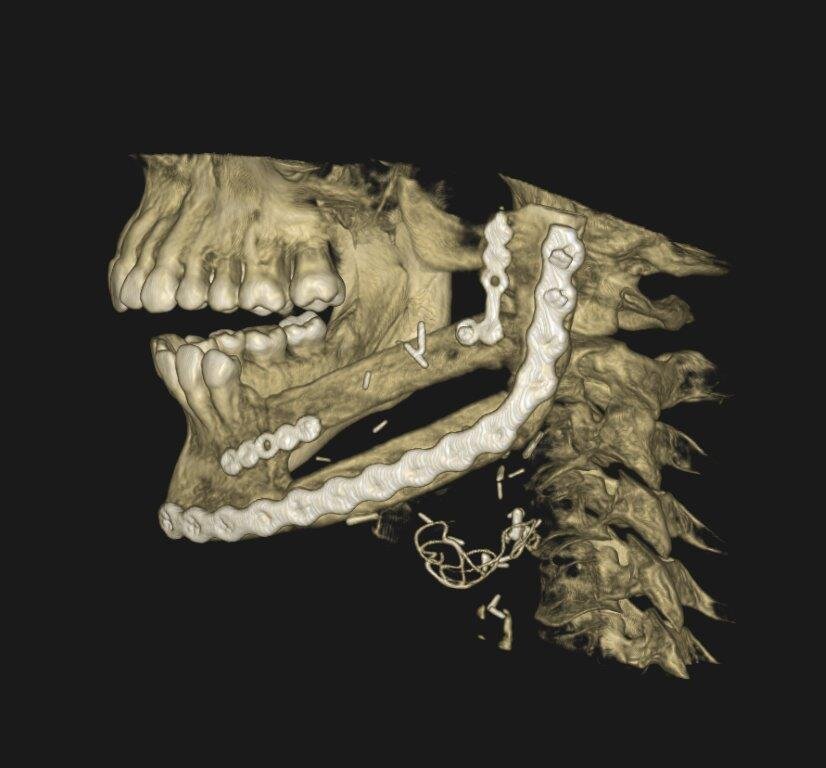 Die Rekonstruktion des Unterkiefers erfolgte mithilfe von Knochenteilen des Wadenbeins, wodurch sowohl die Form als auch die Funktion wiederhergestellt werden konnten.